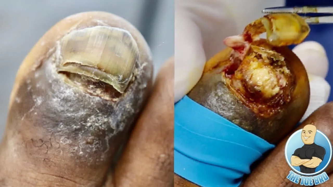 Trench toe is back in the office!!! ***did it heal???***