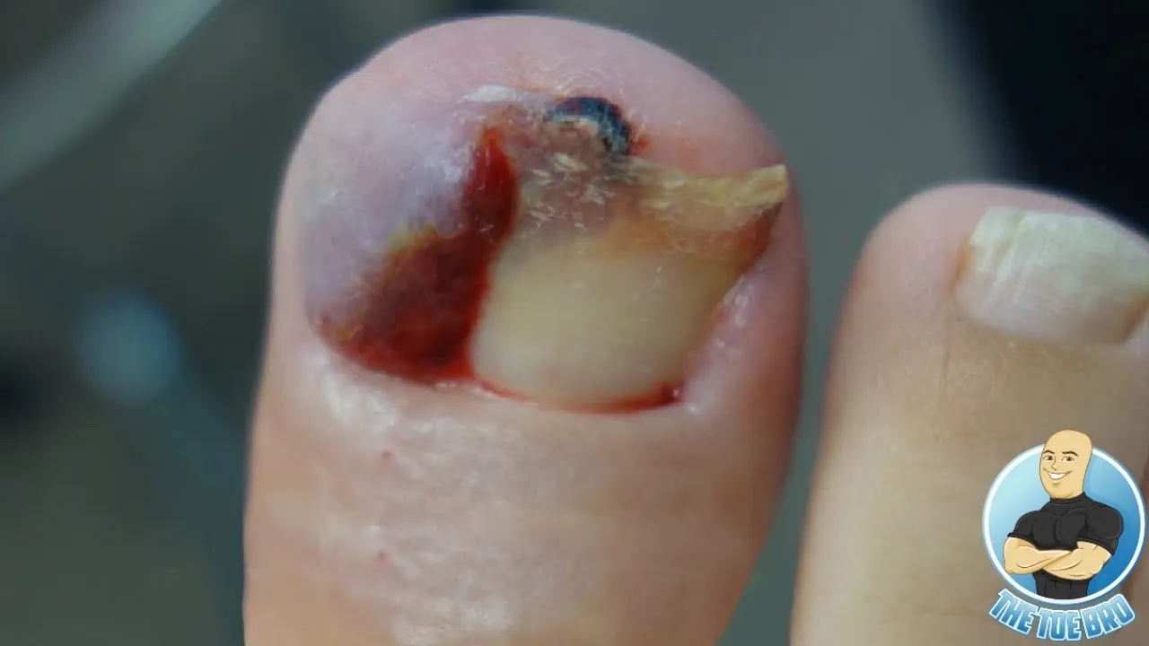 Is her overgrown infected toenail back?!?! ***3 years later***