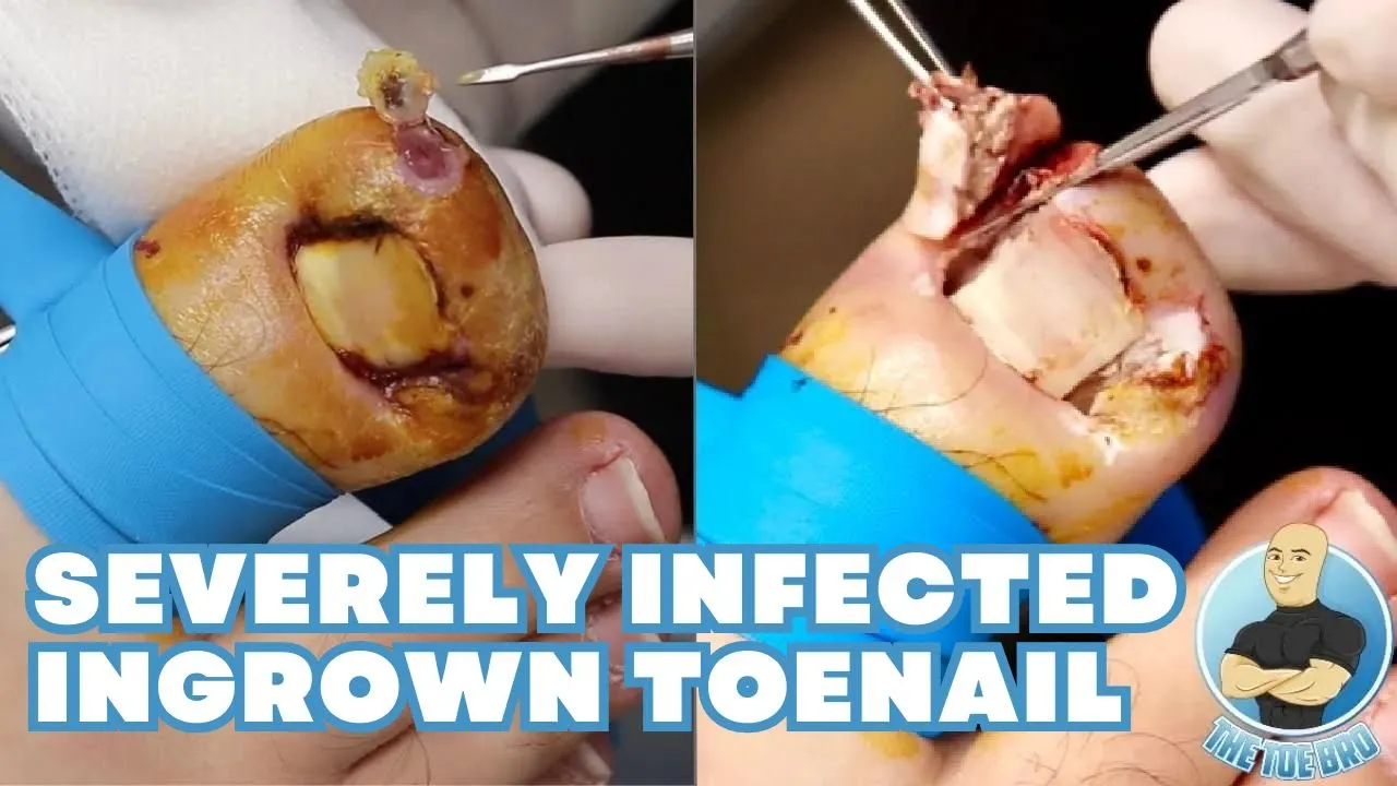 His toenail was poking through his skin!!! ***severely infected ingrown toenail***