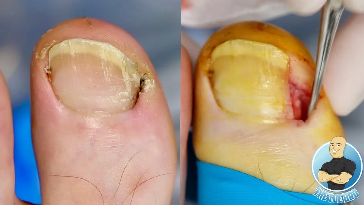 He was told he didn’t have an ingrown toenail...what do you think???