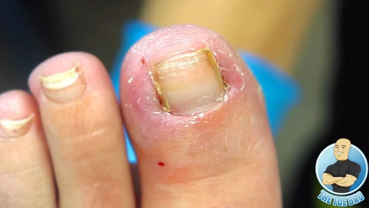 Why does she still have ingrown pain after 2 nail surgeries?! ***hidden surprise???***