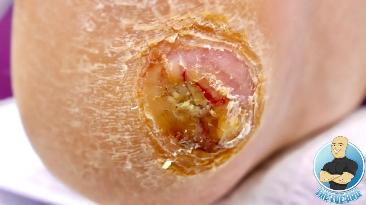 What happened to 'the biggest foot wart ever'??? ***wart removal follow-up***
