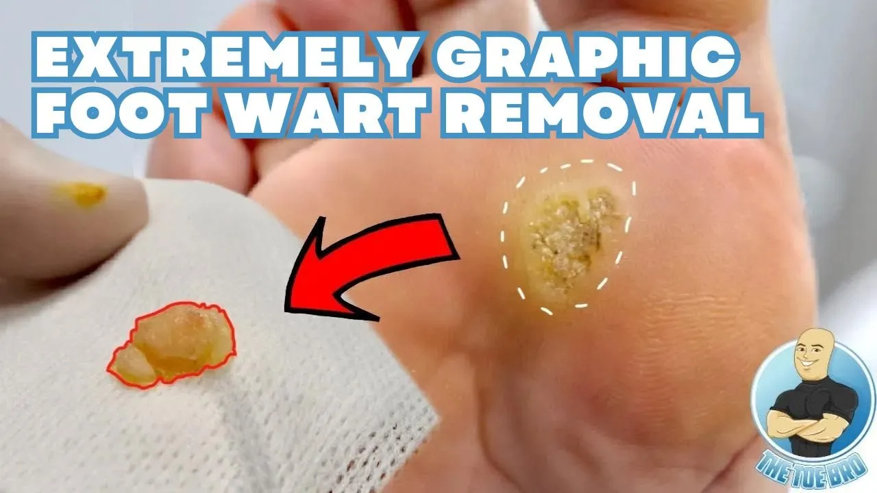 Extremely graphic foot wart removal ****5 years of unsuccessful treatment***