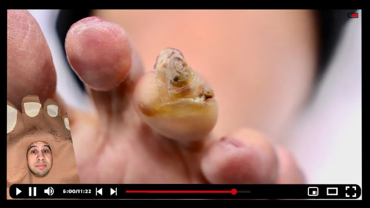 Cutting her massive painful corn