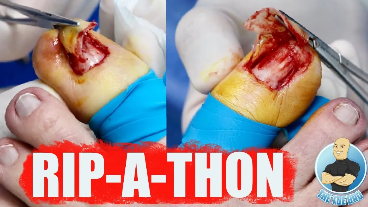 Bye bye toenails!!! ***removing nails forever***