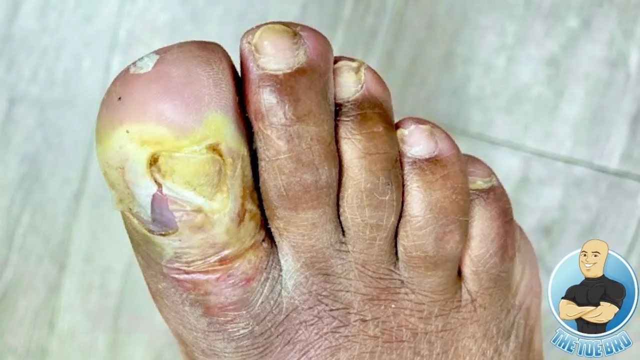 Uncontrolled diabetes can cause major foot issues!!! ***huge toe blister***