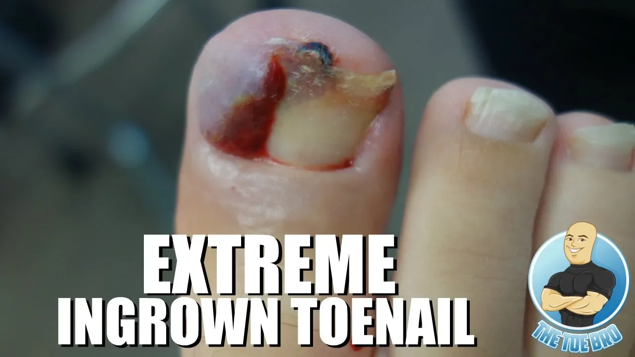 Unbelievable infected ingrown toenail removal