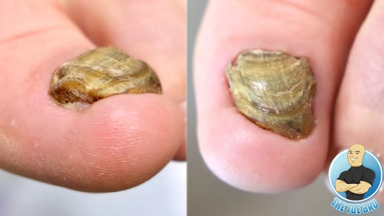 Trying to save her thick deformed toenail!!! ***total nail removal***