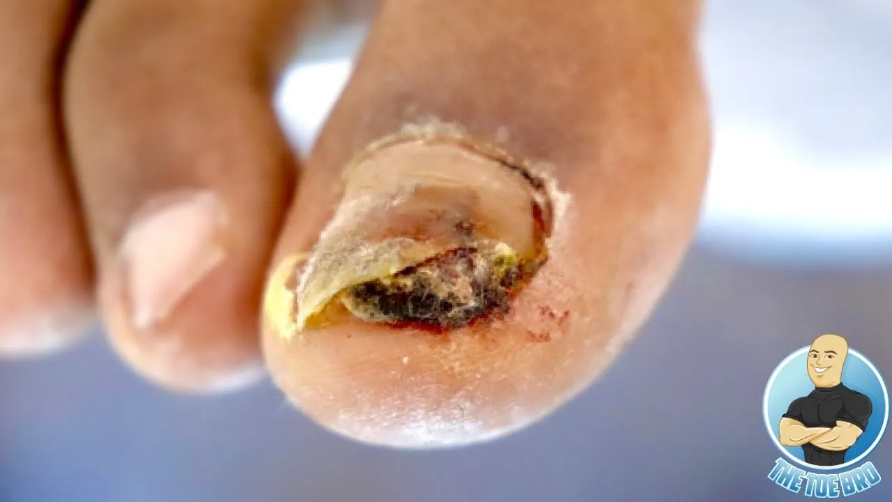 There is something growing under his toenail ***abnormal growth???***