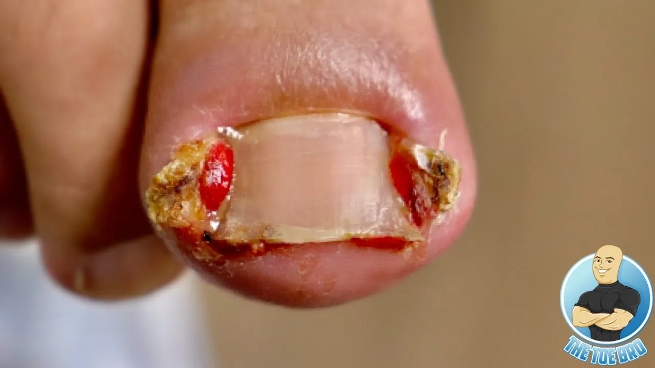 The worst ingrown toenail is back??? ***lots of toe meat removed***