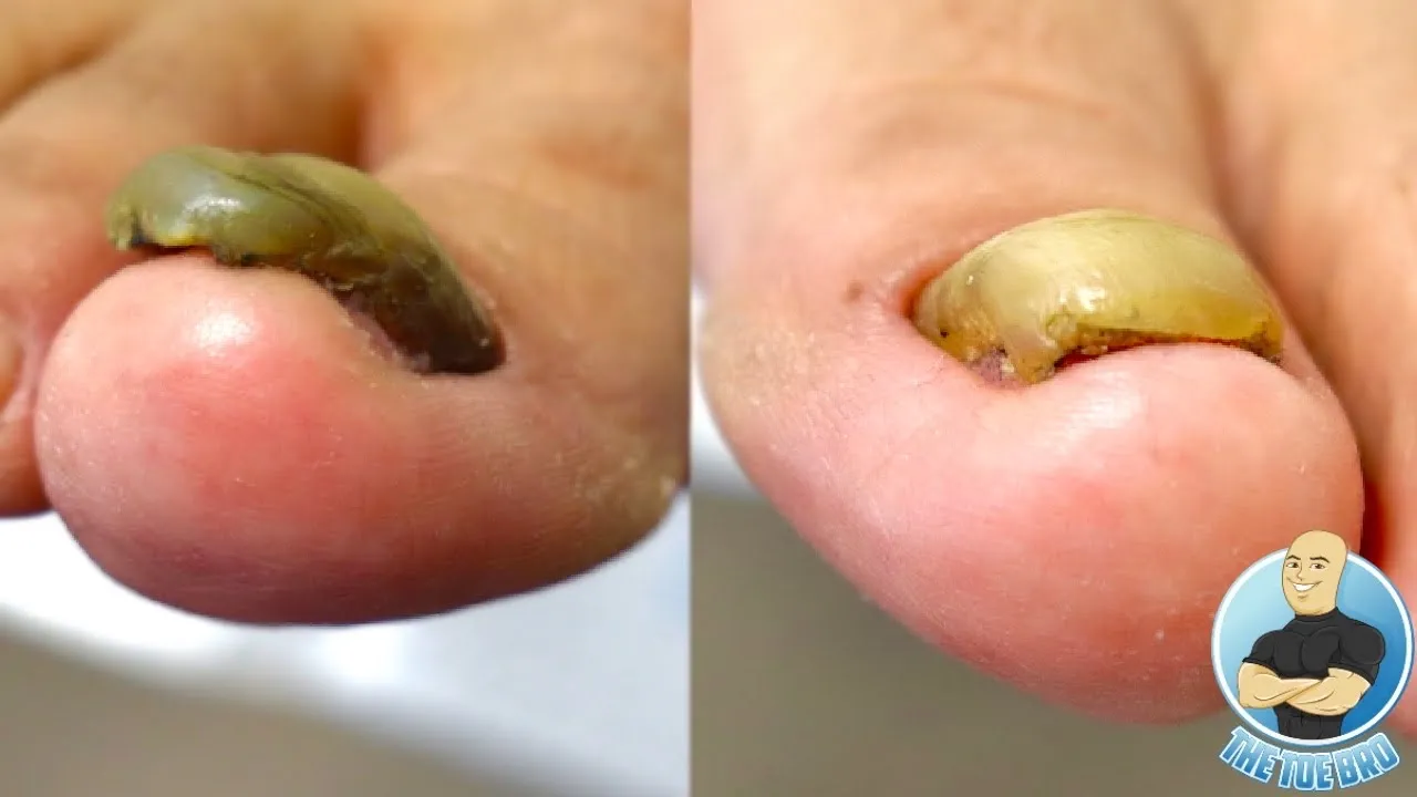 Super thick toenail trimming and filing ***toenail fungus or damaged nails???***