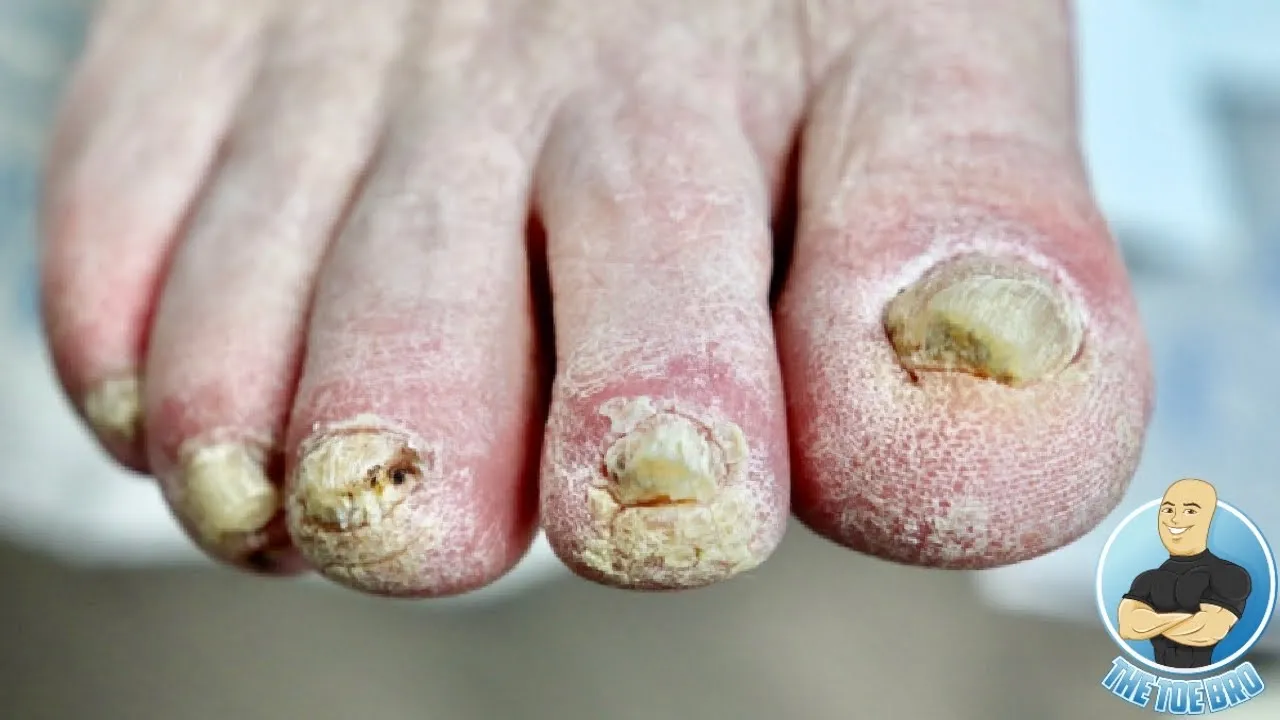 Super dry thick, red itchy toenail trimming
