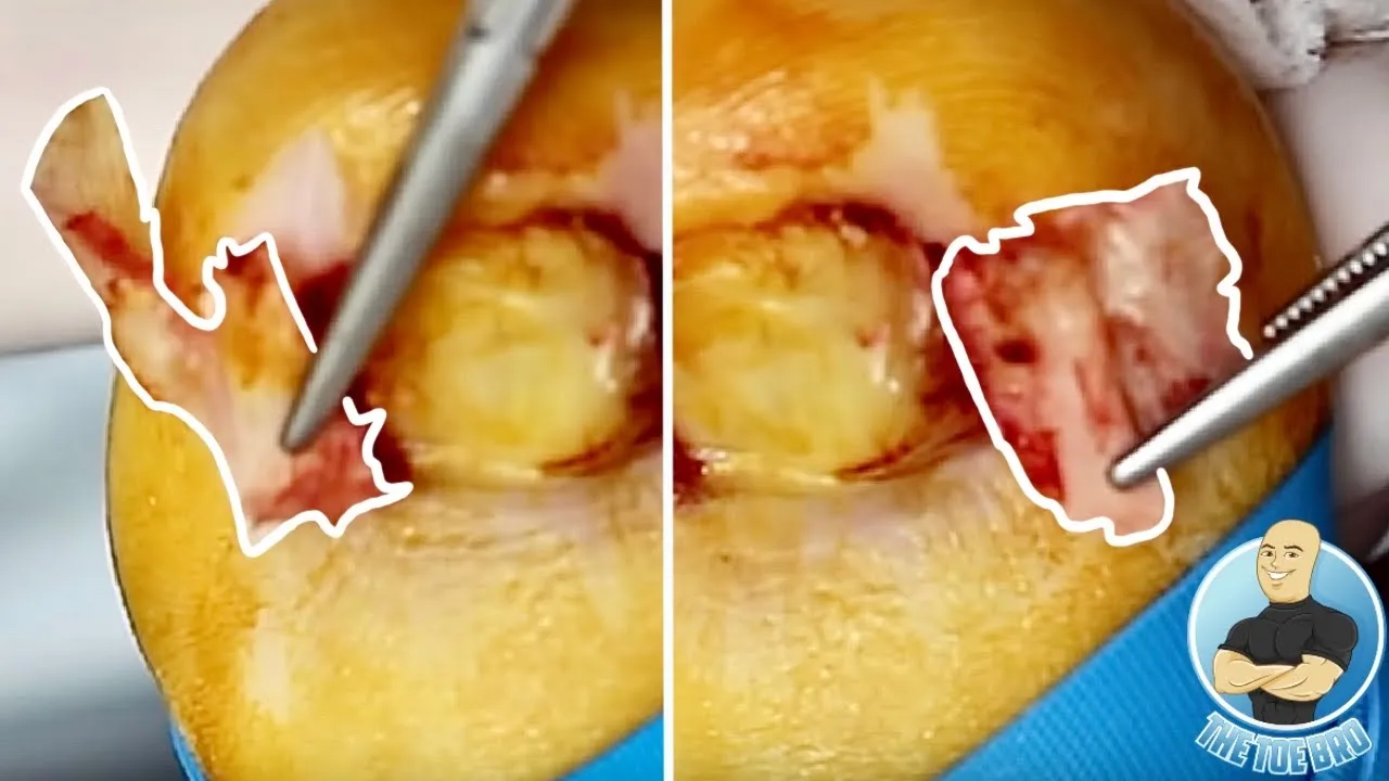 Super deep ingrown toenail removal attached to skin!!!