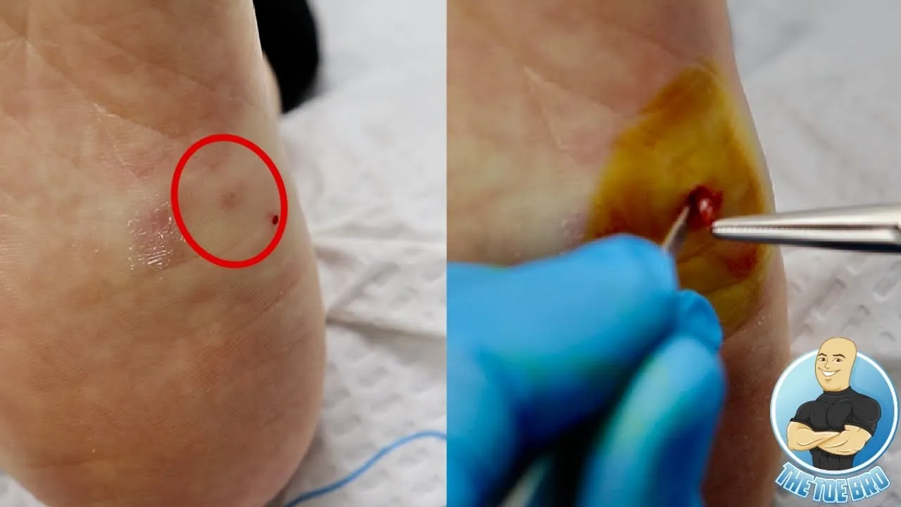 Something is stuck in her foot but what is it???