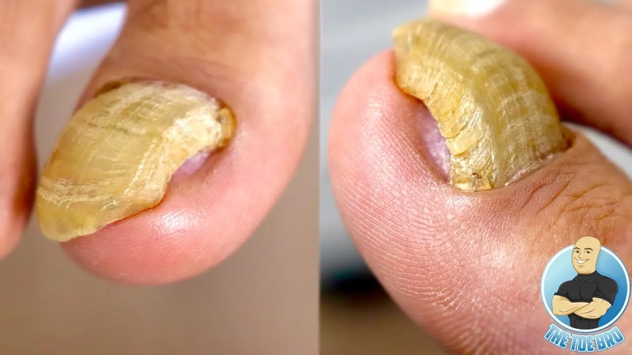 Ripping out and removing a damaged thickened toenail!!!