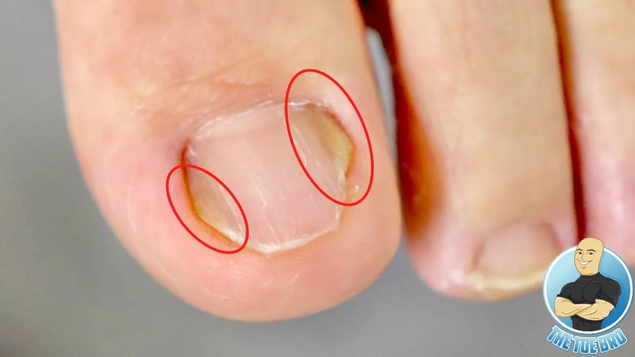 Perfect mix of ingrown toenails & toenail fungus??? ***2 for 1 treatment***