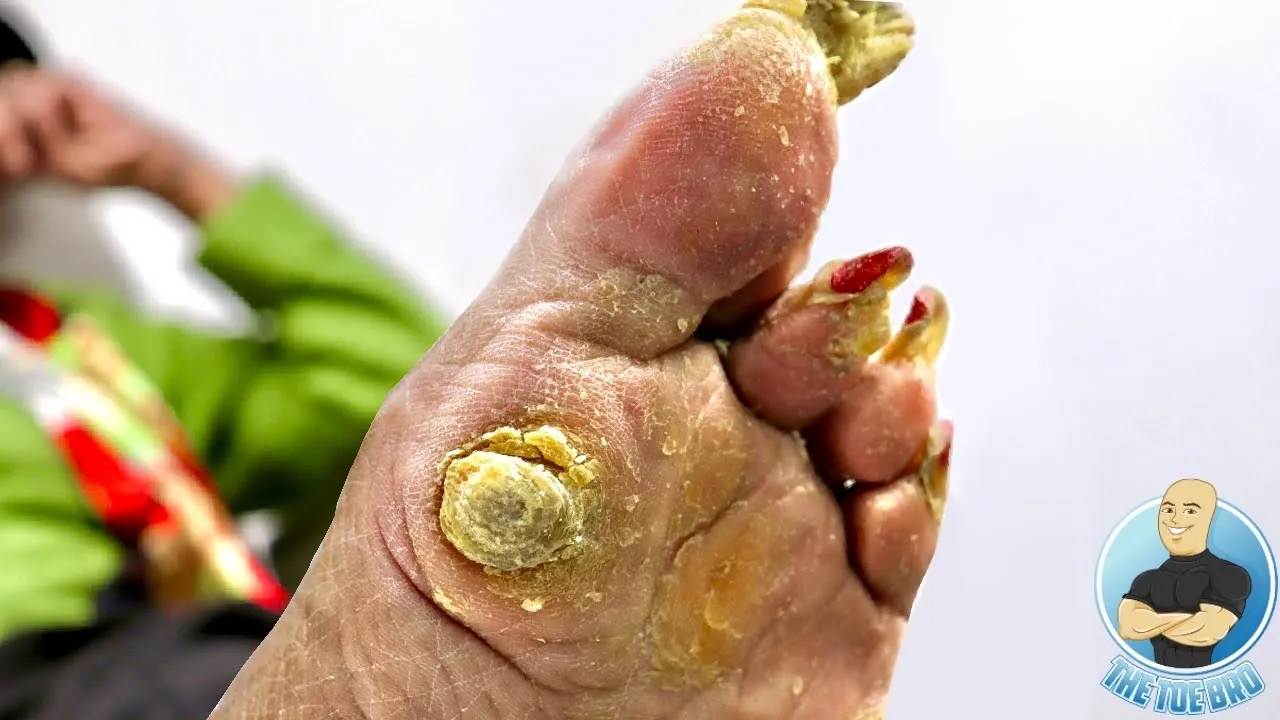 Part 2: super painful callous removal ***she's been hiding her feet for years from her family***