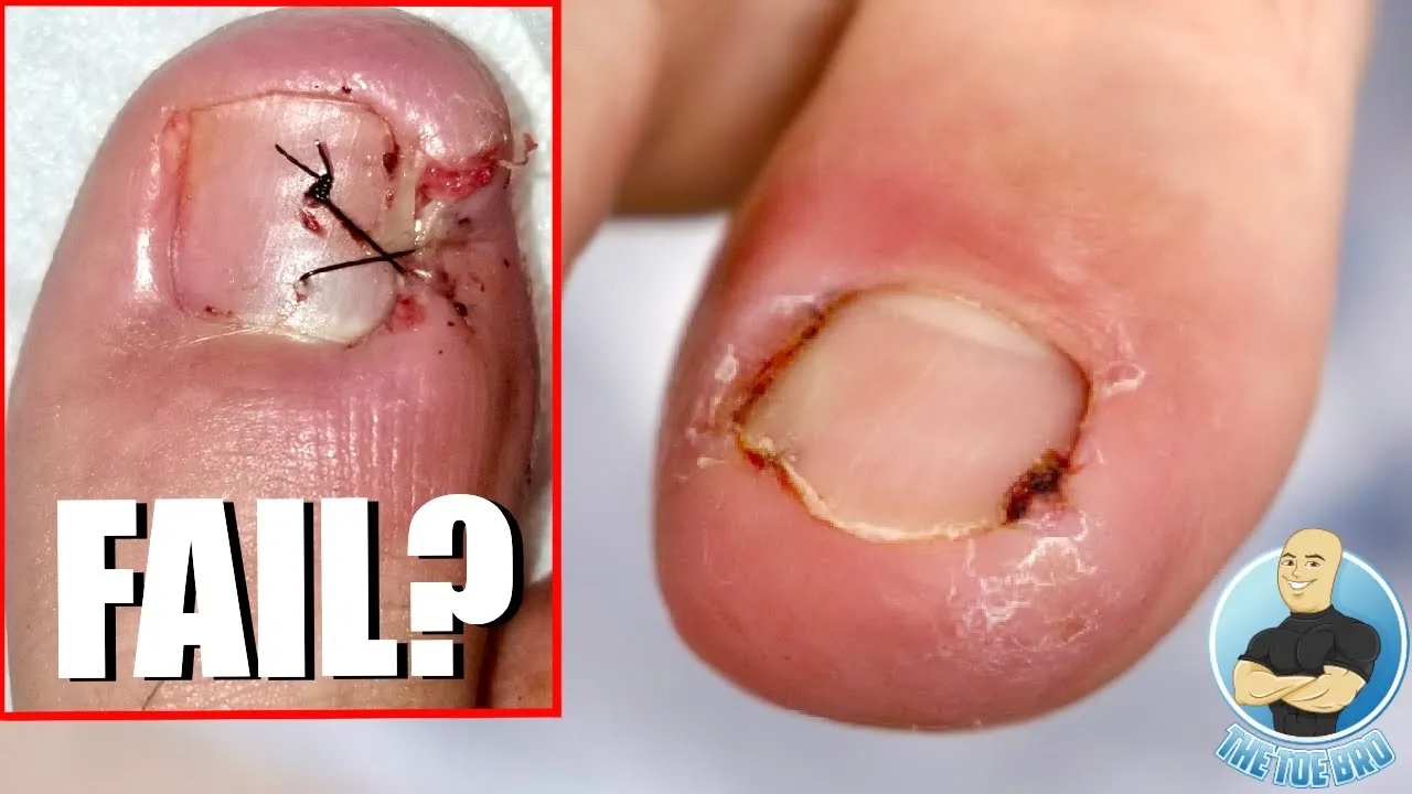 Painful ingrown toenail removal treatment ***last surgery didn't work***