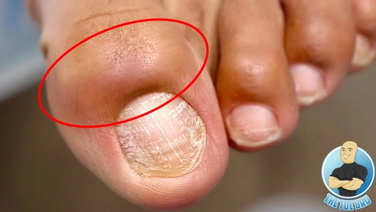 Mysterious painful toenail...what happened?! what do you do???
