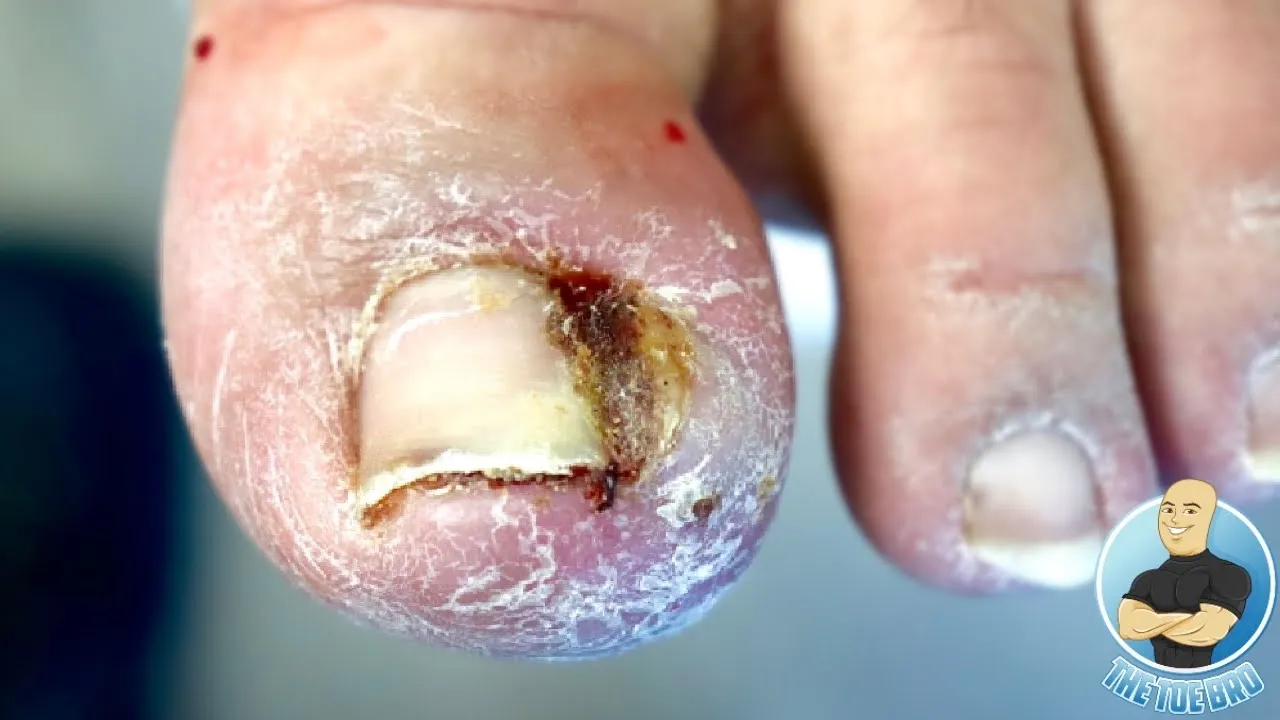 Juicy infected ingrown toenail removal!!!!
