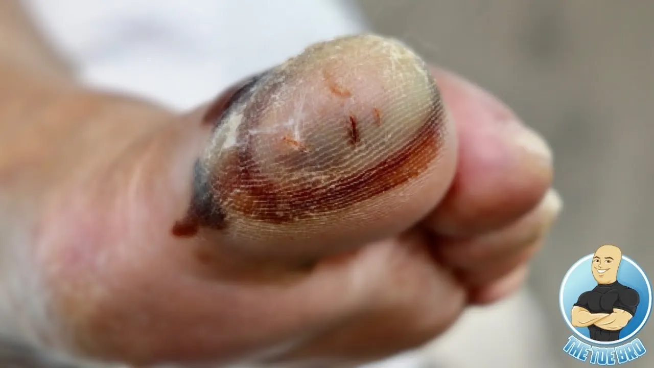 Infected blister gets popped!!! ***what's underneath?!***