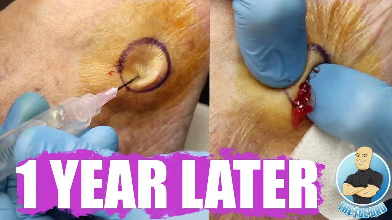 Huge foot bump after 1 year of popping it!!! ***is it gone?!***