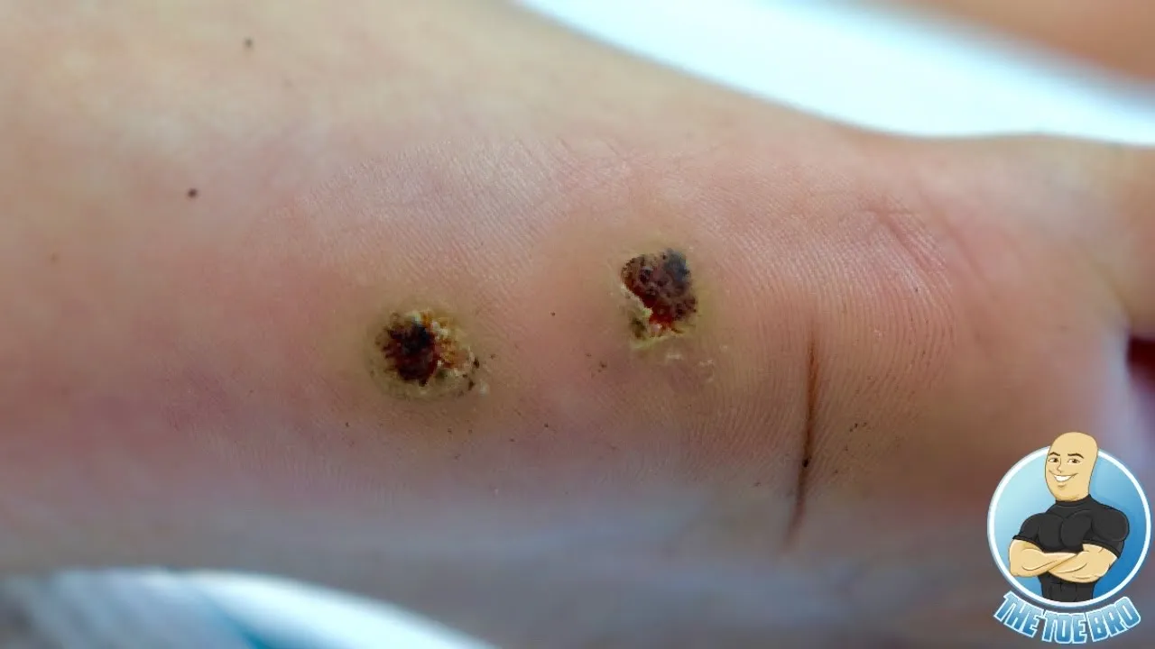 How to deal with painful plantar warts ***surgical removal***