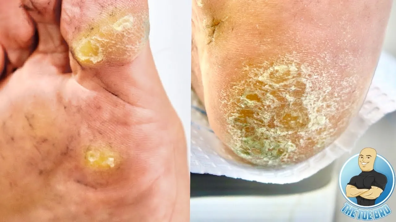 Her corns & calluses are too painful to walk on