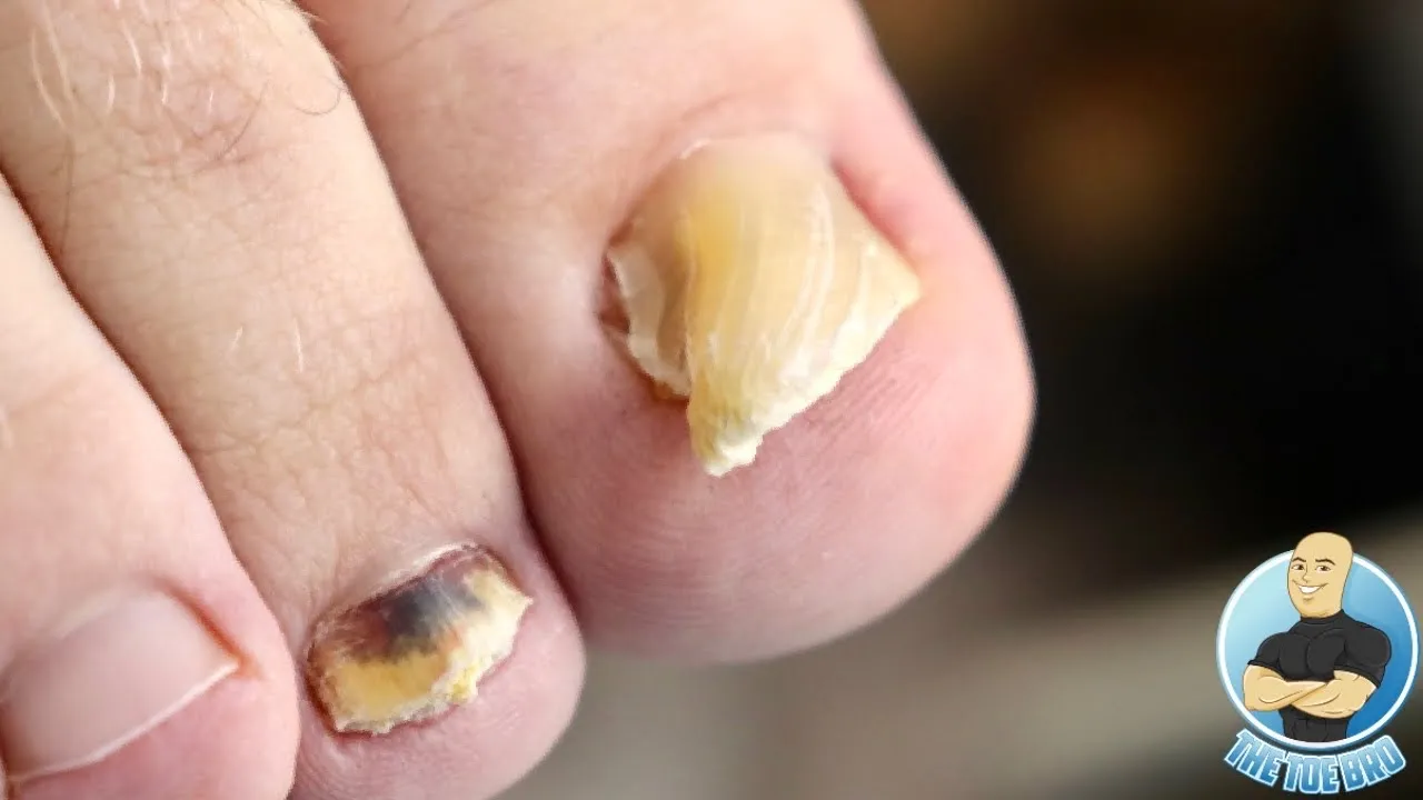 Ever seen a curving thickened damaged toenail before???