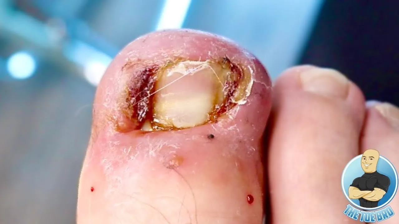 Big juicy infected ingrown nail removal!!!