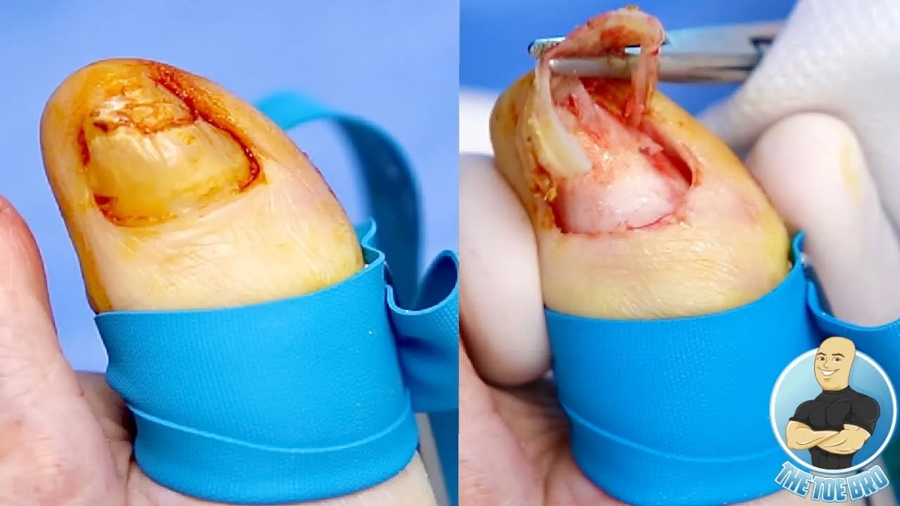 91 year old woman tells me “please remove my toenail forever!!!”