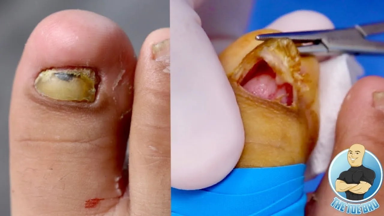 10 year old boy getting his toenail removed?!! ***super brave kid!!!***