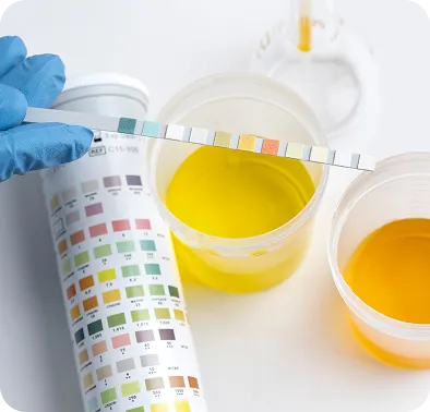 Gloved hand holding a urine test strip over two cups of yellow liquid with a color comparison chart in the background.