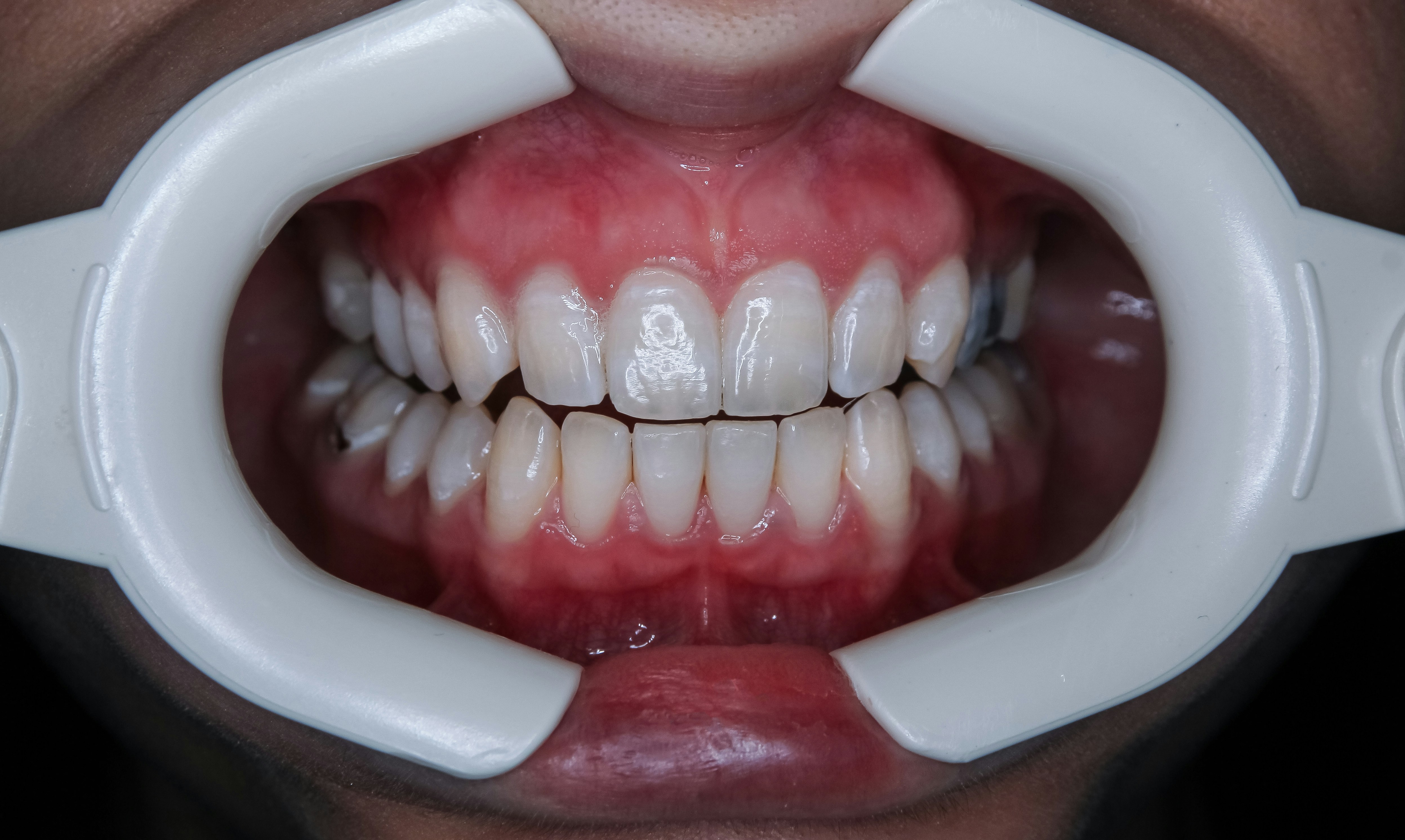 a closeup shot of a person's teeth and gum