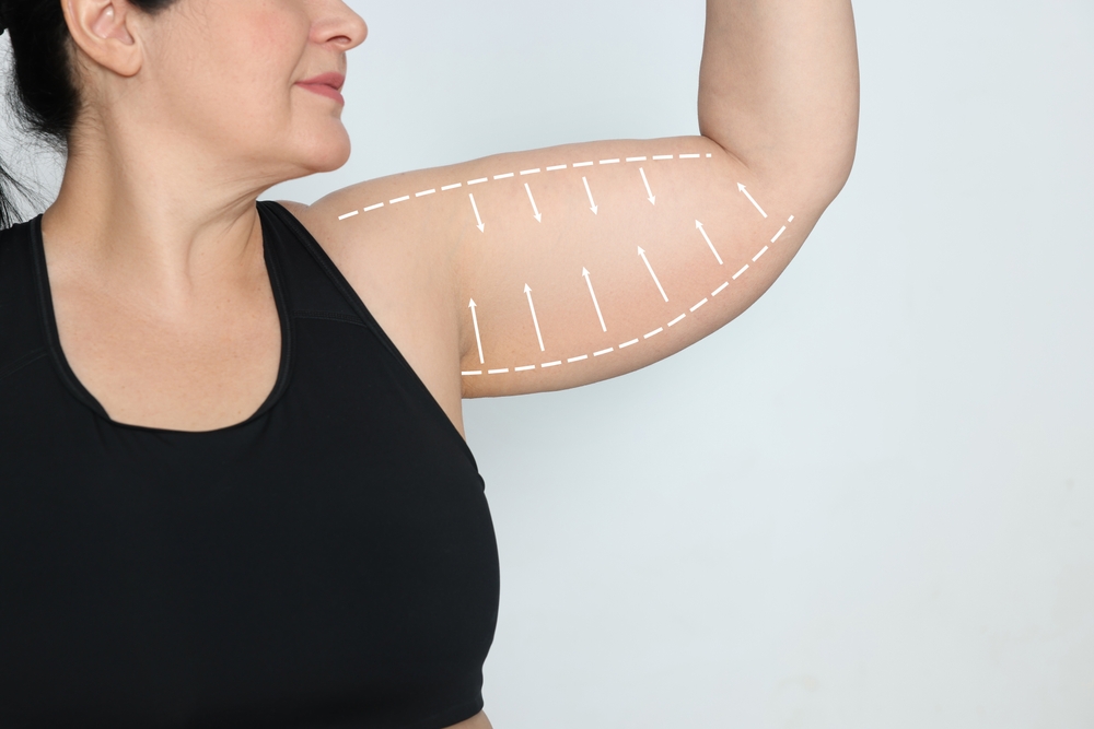Body contouring after weight loss