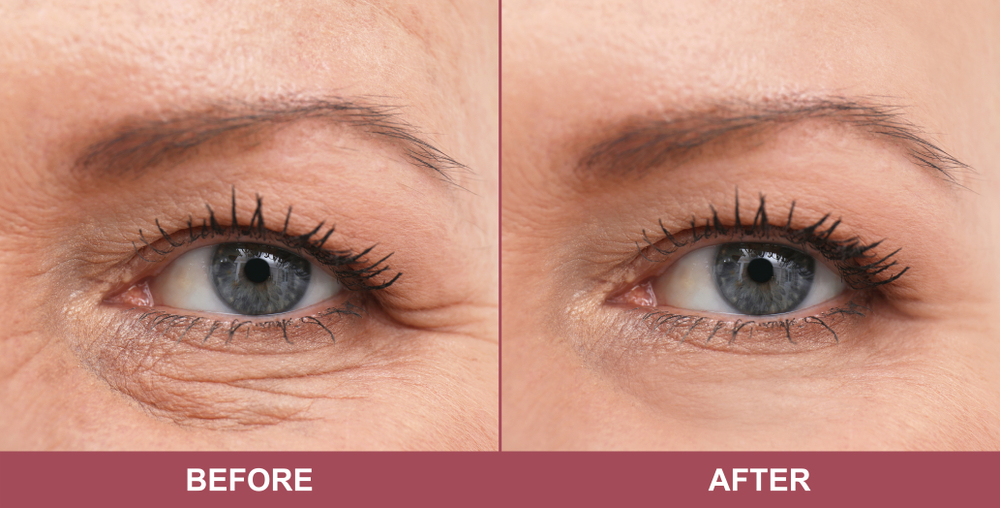crow's feet Botox