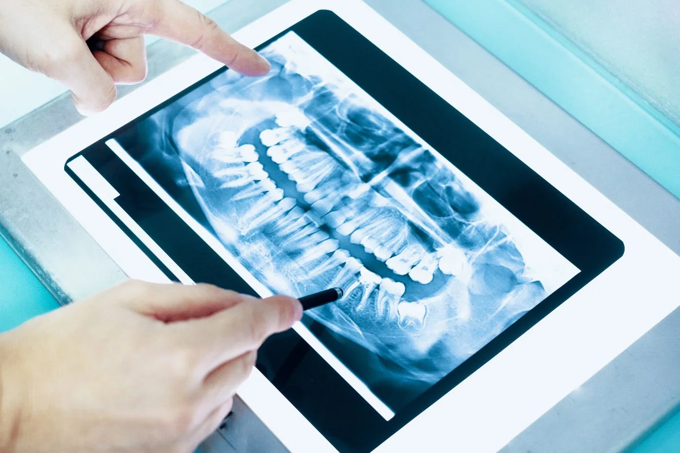 extractions in santee