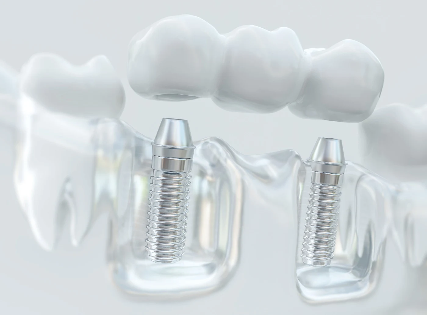 Dental implants in Santee