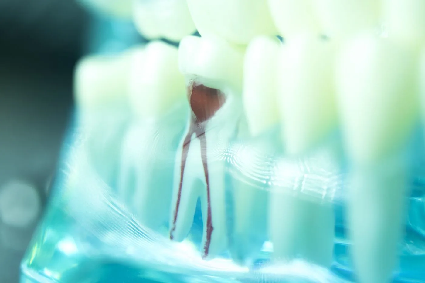 Root canals in Santee