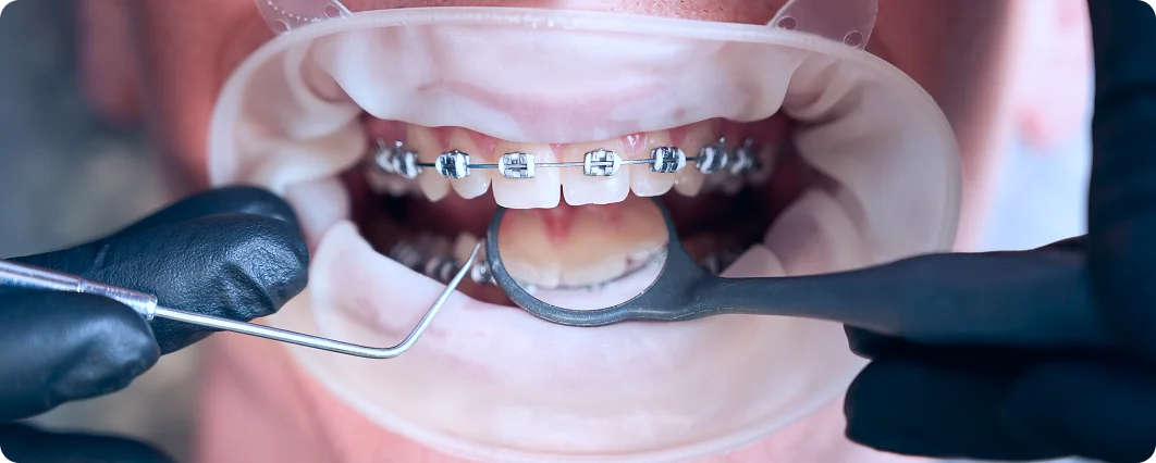 Orthodontic Treatment