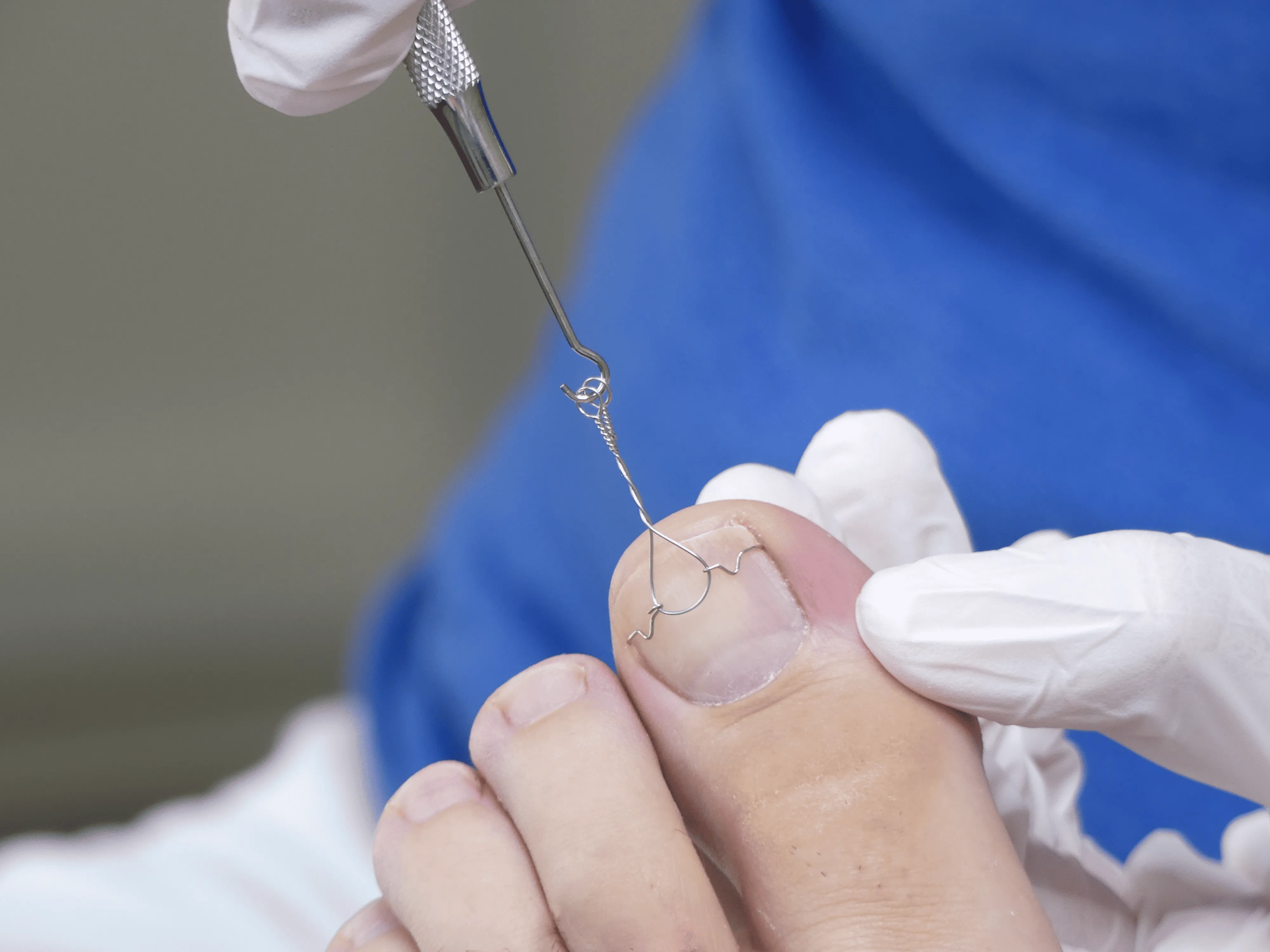 ehandlung von Zehennägeln mit einem Draht