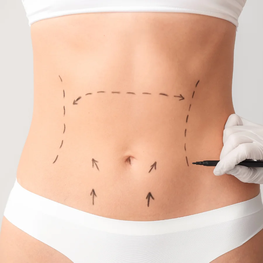 Chirurgie de la silhouette