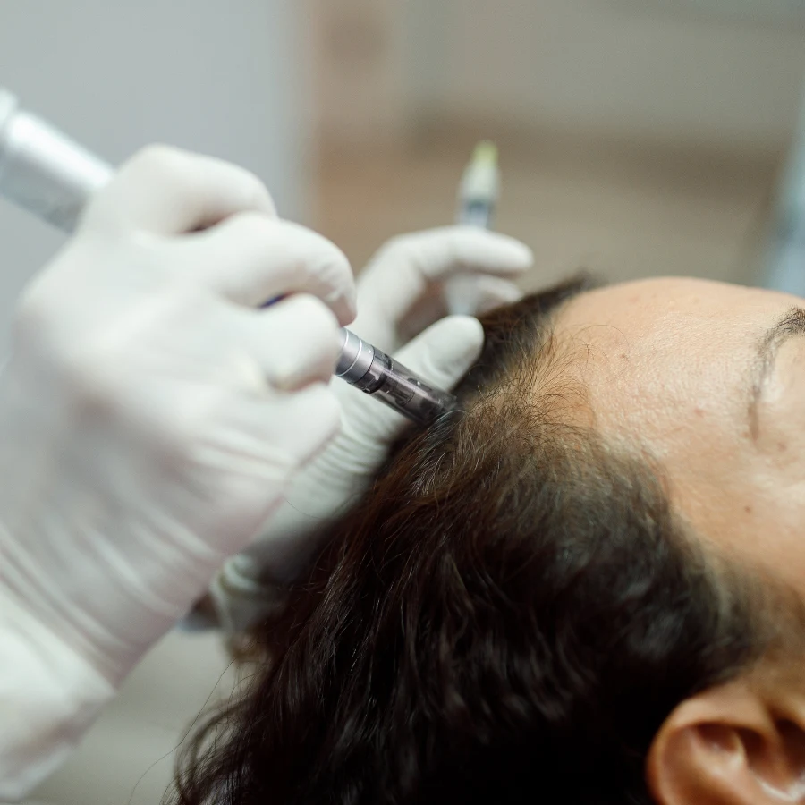 Microneedling capillaire