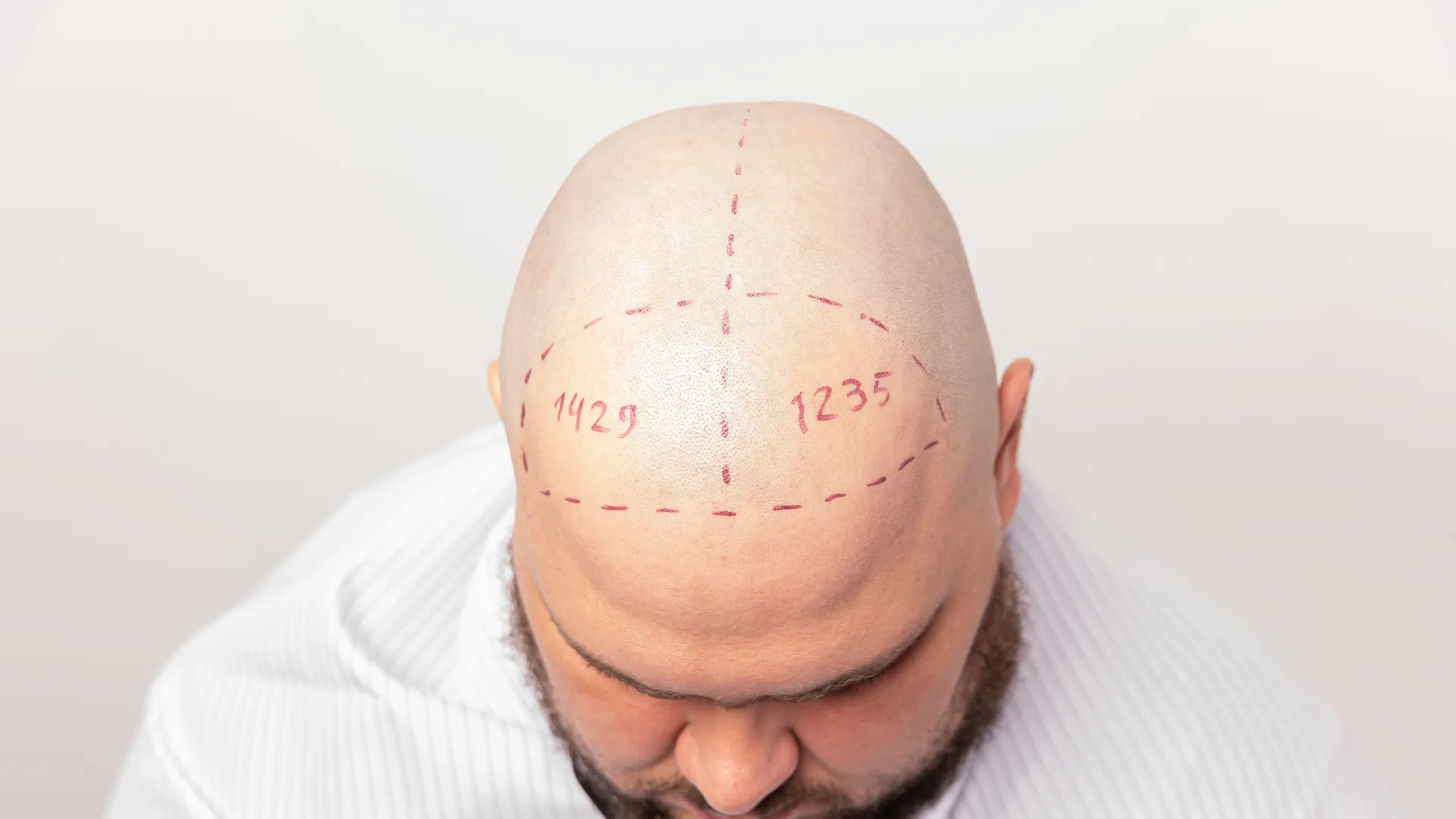 Préparation d'une greffe capillaire avec zones du cuir chevelu marquées et numérotées