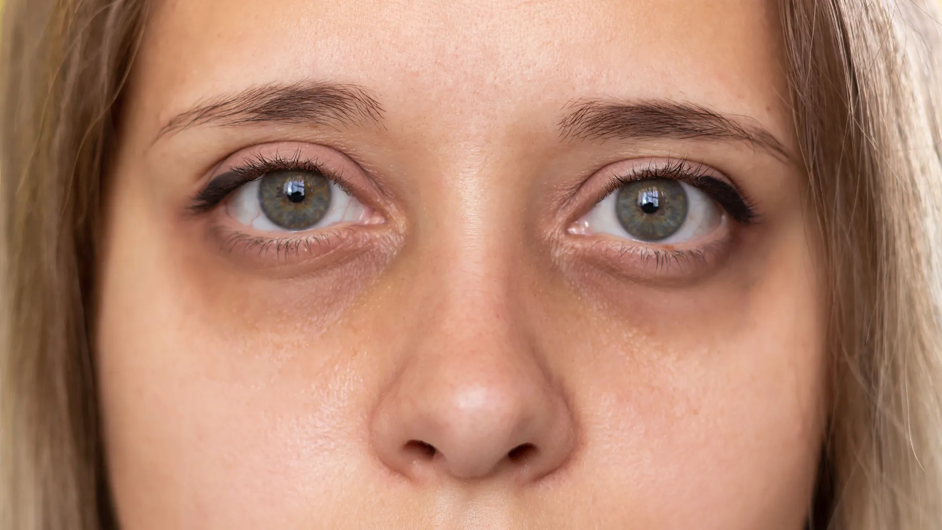 Cernes creux : acide hyaluronique ou skinbooster ?