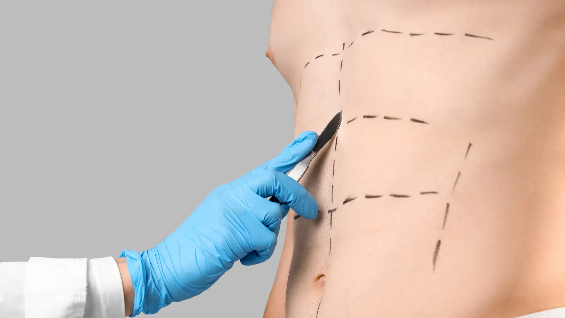 Abdominoplastie ou mini-abdominoplastie : comment choisir ?