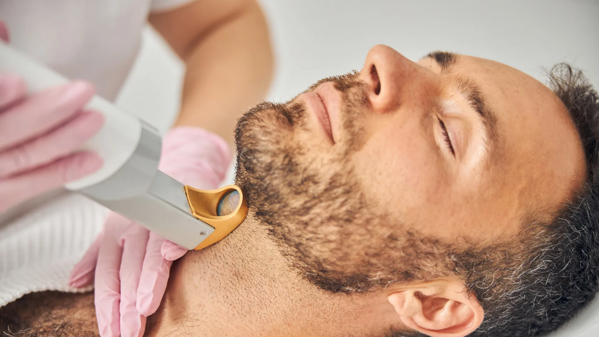 Épilation laser homme : zones populaires et résultats à Paris