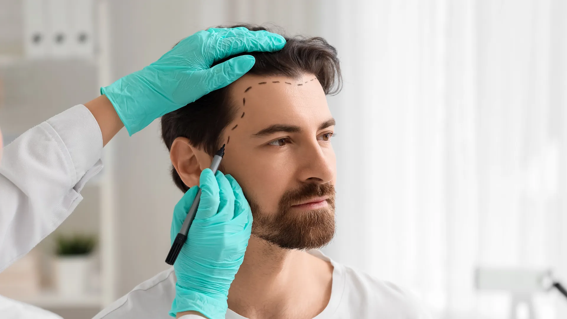 Marquage de la ligne frontale avant une intervention de greffe capillaire chez un patient.