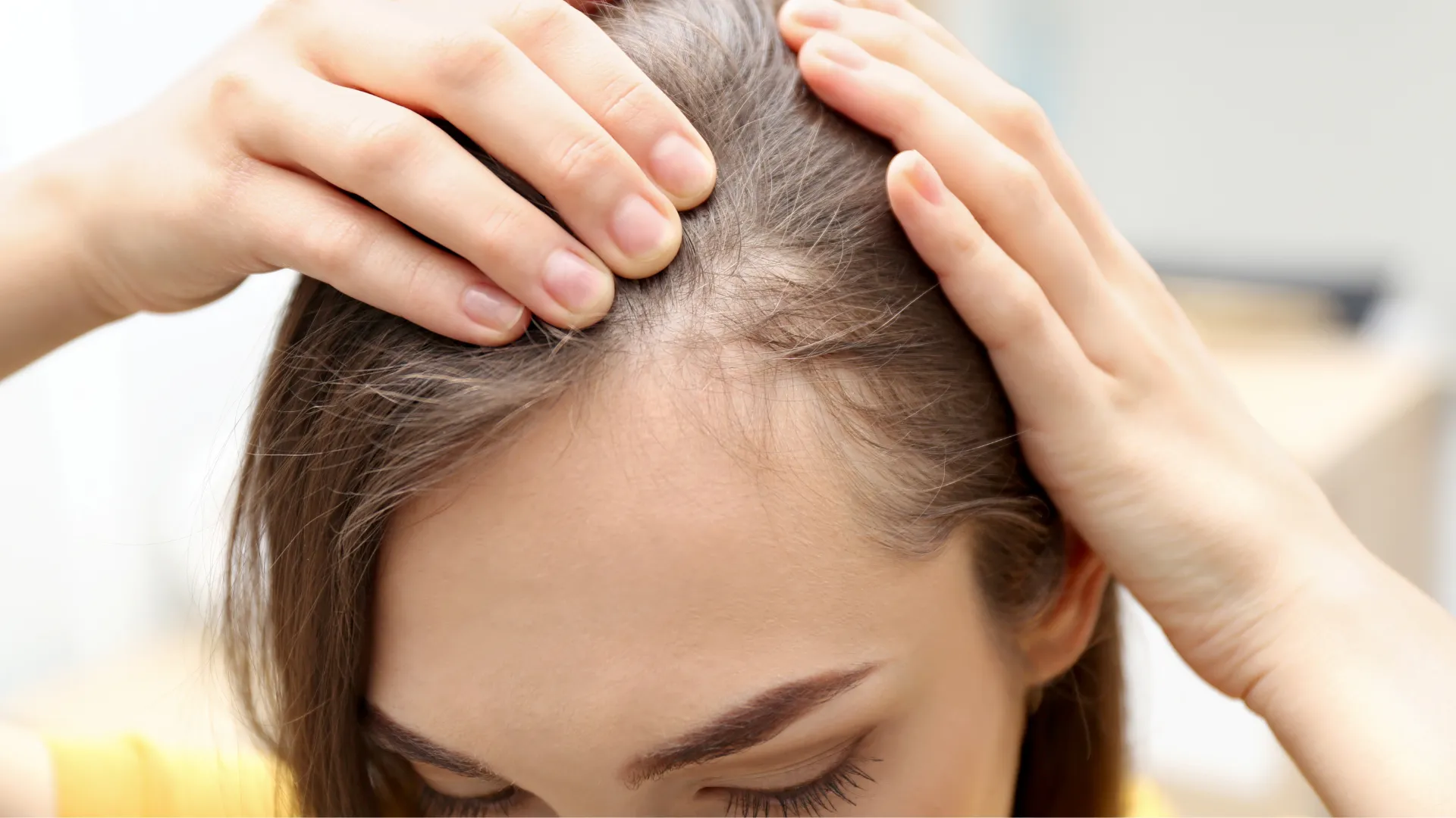 Greffe capillaire femme : techniques, indications et résultats