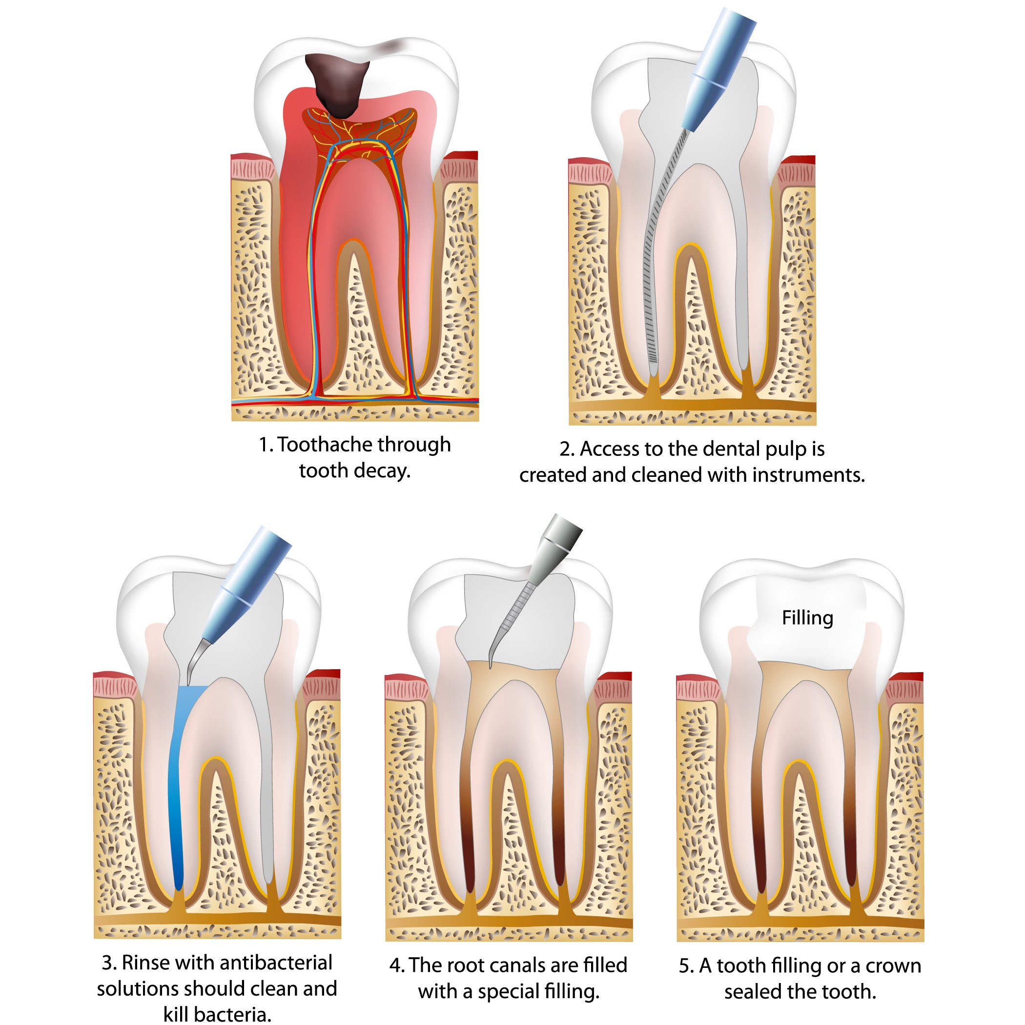 Image of root canal procedure steps